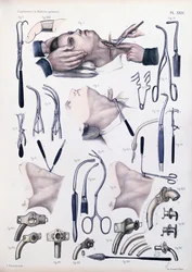 Opération de trachéotomie, planche tirée de 